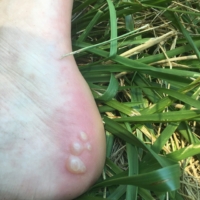 Oh the pain of blisters ...