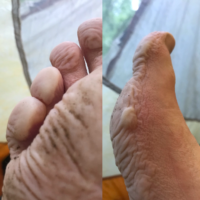 My feet are continuing to balloon. Check out that pinky toe! Yuck. Kind of fascinating, in a gross way. I don't think I can walk tomorrow .... (1/2)